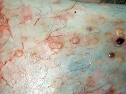  Imagen que muestra las lesiones producidas en la cara interna de la piel
por las garrapatas en el punto de fijación al animal.