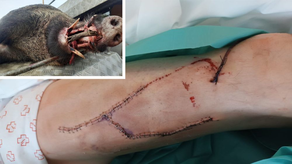 Un jabalí de 130 kilos y 19 centímetros de colmillo destroza la pierna de un montero gallego